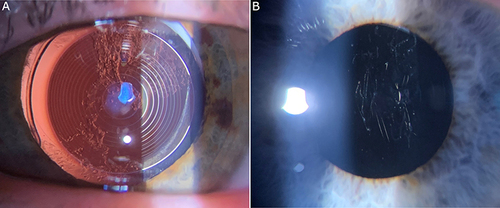 Figure 1 Early postoperative posterior capsule opacification (PCO) in symptomatic trifocal patients. (A) Grade 1+ PCO without capsular wrinkles. (B) Grade 1+ PCO with prominent capsular wrinkles.