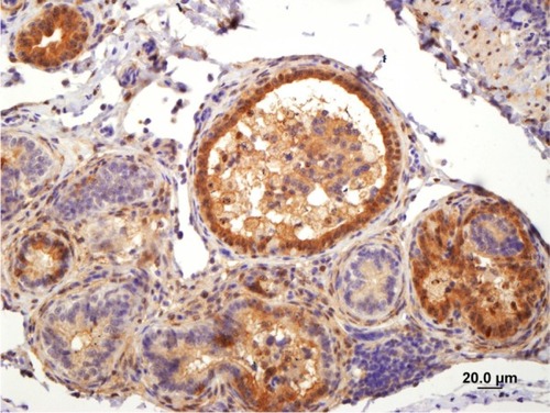 Figure 3 Immunohistochemical staining for borna disease virus polymerase protein in the kidney.