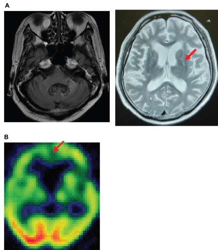 Figure 2 MRI (A) and SPECT (B) findings in day 92 after administration demonstrating not significant changes in MRI and SPECT.