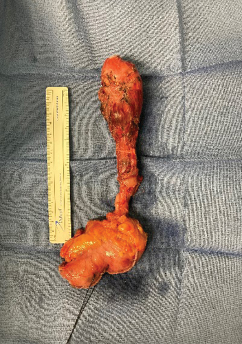 Figure 4. Surgical specimen.Excised esophageal segment with proximal segment of fundus of stomach.