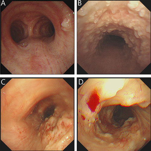 Figure 2 Bronchoscopic results of TO in different stages. (A) Stage I: Scattered nodular protrusions in the lower part of the trachea near the bulge; (B) Stage II: Diffuse distribution of nodular protrusions on the anterior and lateral walls of the trachea; (C and D) Stage III: Deformation and narrowing of the lumen.