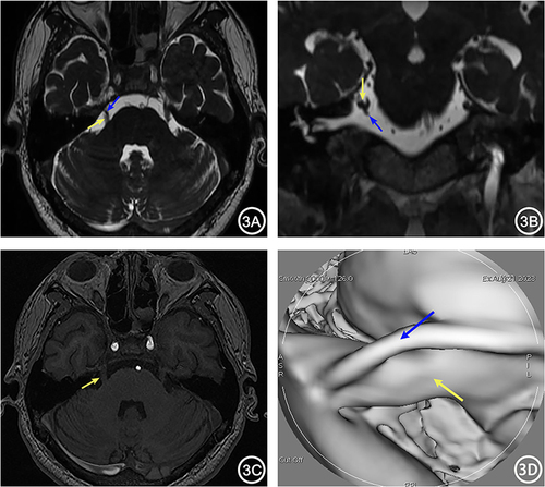 Figure 3 A 65-year-old male with right TN for 4 years. 3D-FIESTA-c axial (A) and coronal (B) showed close contact between the right Petrosal Vein (blue arrow) and the trigeminal nerve (yellow arrow) below. 3D-TOF-MRA axial (B) showed no apparent responsible vessels around the right trigeminal nerve (yellow arrow). MRVE image (D) showed the intimate relationship between the right Petrosal Vein (blue arrow) and the trigeminal nerve (yellow arrow).