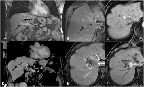 Figure 3. 80-year-old-man with colorectal cancer and a unique liver metastasis (black arrow) close to a segmental portal vein (black doted arrow). A and B represent a coronal and axial T1 weighted MRI after intravenous contrast injection with an acquisition during the portal phase before microwave ablation. C represents the aspect of the ablation zone on T1 weight MRI one month after treatment. Without injection of contrast the ablation zone appears hyper intense (white arrow). D, E and F are a coronal and axial T1 weighted MRI without injection (F) and with intravenous injection of contrast (D and E) during portal phase, three months after microwave ablation representing a growing tumor (dotted line) poorly enhanced abutting the ablation zone and the portal vein.