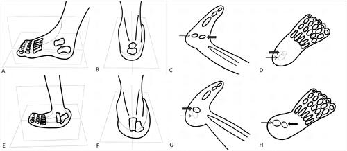 Figure 1. Diagrams show the method to obtain detailed feet anatomic structures in sagital and axial sections in normal and CVT fetuses. (A, B) These figures show diagrams of ultrasound views of the talus and calcaneus ossification centers observed in the normal fetal foot, with sagittal and axial sections. (C, D) These figures respectively show the position of the talar and calcaneus ossification centers on the ultrasound image when a normal fetal foot is viewed in sagittal (C) and axial (D) views. (E, F) These figures show diagrams of ultrasound views of the talus and calcaneus ossification centers observed in the foot of a CVT fetus, with sagittal and axial views. (G, H) These figures respectively show the position of the talar and calcaneus ossification centers on the ultrasound image when a CVT fetal foot is viewed in sagittal (G) and axial (H) views (The ossification centers of the talus and calcaneus that cannot be shown on the ultrasound image section are indicated in light color, and those that can be observed are indicated in black. Bold arrow points to the talus, slim arrow points to the calcaneus).