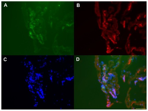 Figure 5 Immunoreactivity of surgically removed epiretinal membrane for vascular endothelial growth factor (A) and von Willebrand factor (B). (C) Nuclear staining of the same section. (D) Triple labeling.