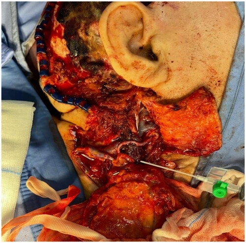 Figure 3. Latissimus dorsi muscular free flap anastomosis.