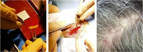 Figure 3 Excision of the temporalis fascia after surgical incision of the temporal scalp.