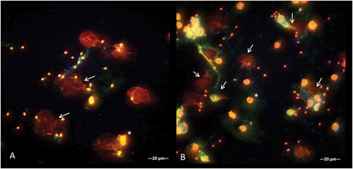 Figure 3. Representative images of the co-localization areas of three immunofluorescence channels (merge) experiment on extracellular DNA and histones in spermatozoa-induced METs structures (‘diffuse’ METs) (white arrow) (*indicate monocytes). (A) Co-incubations of monocytes + spermatozoa. (B) Co-incubations of monocytes + spermatozoa + E. coli.