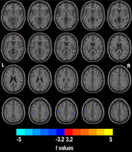 Figure 1 Changes in ReHo in the PD-CN group compared with the NC group (P<0.05, corrected with Bonferroni method). Regions with significantly increased ReHo included the right middle frontal gyrus (MFG). Regions with significantly decreased ReHo included the left supramarginal gyrus (SMG), bilateral inferior parietal lobule (IPL), and right postcentral gyrus (PCG).