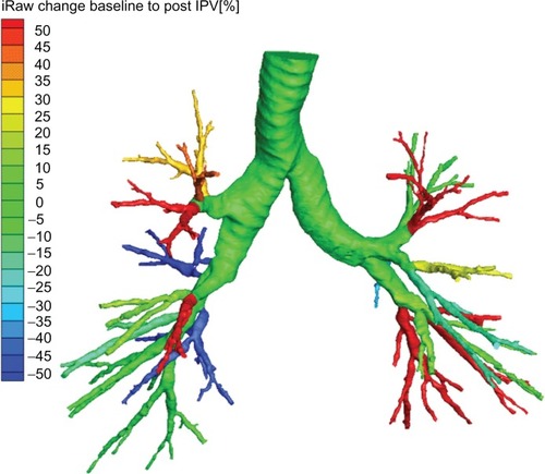 Figure 1 Changes in airway resistance pre–post intrapulmonary percussive ventilation (IPV) in one representative COPD patient, using a computational fluid dynamic imaging technique.