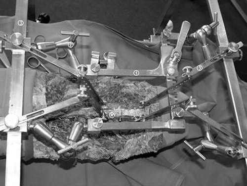 Figure 2. The spine frame includes a soft tissue retractor (1; Ulrich, Germany) that is fixed by four adjustable joint arms (2) to the horizontal rods (3) of the frame. The fixation of the spine is provided by a clamp (4) directly mounted on the spinal processes and linked by titanium arms (5) to the frame.