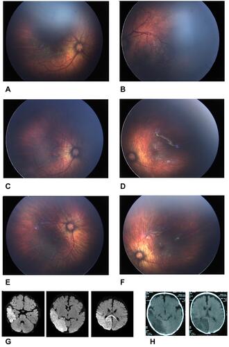Figure 1 (A and B) Fundus photographs of right and left eye of the patient at the 50 weeks postmenstrual age (PMA) show aggressive posterior ROP (flat neovascularization) in zone 1, on the same day intravitreal aflibercept injected. (C and D) fundus photos at the 65 weeks PMA show regression of neovascularization but stop in vascularization at zone 1 in both eyes. (E and F) fundus photographs at the 75 weeks PMA show still complete stop in vascularization at zone 1 in both eyes. (G) diffusion-weighted axial MRI images evidence diffusion restriction at right occipital and parietal lobes and also splenium of the corpus callosum, compatible with acute ischemic non-hemorrhagic infarct. (H) axial CT scan shows the same findings.