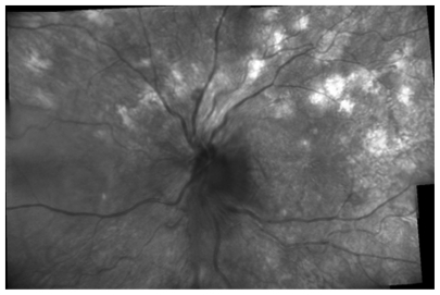 Figure 2 Infrared montage of the left eye showing the optic disc surrounded by small exudates and choroidal lesions in the posterior pole midperiphery.