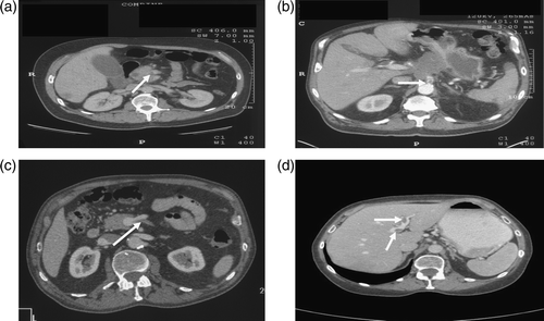 Figure 1 a–d.  “Silent” thrombosis of the splanchnic vessels in advanced pancreatic cancer patients. a: Thrombus in the superior mesenteric vein (arrow), b: thrombus in the origin of the celiac axis (arrow), c: thrombus in the inferior mesenteric vein (arrow), d: thrombosis in the left portal vein system (arrows).