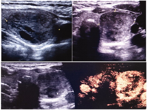 Figure 1. US scans in a 57-year-old woman: (a) US scans showed that the largest diameter was 3.67 cm; (b) US scans showed that the two other perpendicular diameters were 2.46 cm and 2.28 cm, respectively. (c) Contrast-enhanced ultrasonography (CEUS) showed a cyst-solid mixed TN. The TN’s volume was 10.8 ml, of which the solid portion was 95.1%; the arrow highlights the central region of the TN.