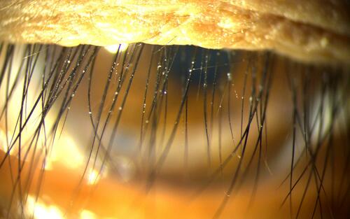 Figure 2 Slit-lamp photograph of scaly debris, appeared as flakes adhered on eyelashes.