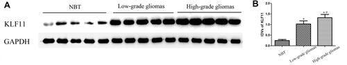 Figure 2 Expression of KLF11 was detected by Western blot analysis in glioma tissues and normal brain tissues. (A) The expression KLF11 was higher in glioma tissues than that in normal brain tissues (NBT) using GAPDH as an endogenous control. (B) Western blot statistical analysis results showed the KLF11 expression was associated with gliomas grade. *P<0.05 vs NBT group, #P<0.05 vs low-grade gliomas group.