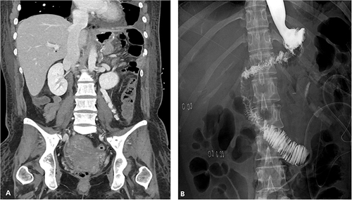 Figure 3 (A) Early postoperative coronal computed tomography (CT) scan after total gastrectomy and splenectomy due to incarcerated left diaphragmatic hernia. (B) After postoperative and delayed delivery, upper gastrointestinal (UGI) series with gastrografin swallow show no evidence of contrast leakage or passage disturbance at the anastomosis site.