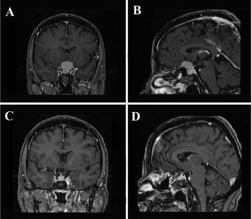 Figure 2. Case 2. Preoperative coronal (A) and sagittal (B) contrast-enhanced T1-weighted MR images showing a large TSM with inferior sellar extension and midline location. Postoperative coronal (C) and sagittal (D) contrast-enhanced T1-weighted MR images showing GTR of the TSM.