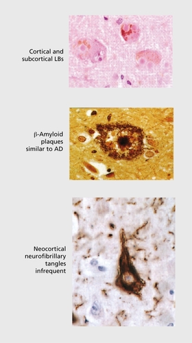 Figure 1. The neuropathology of dementia with Lewy bodies (DLB). LBs, Lewy bodies; AD, Alzheimer's disease.