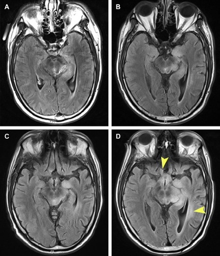Figure 4 Axial FLAIR T2 (TR:500, TI:2500, TE:125) weighted MRI images taken at approximately the same levels in the region of the midbrain for case 2.