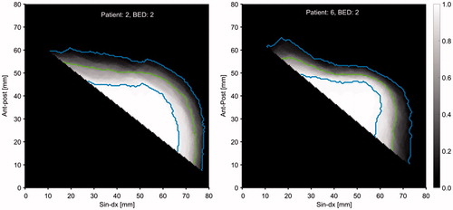 Figure 5. Merged axial view of the HE distribution for all CT scans at bed 2 for patient 2 (left) and bed 2 for patient 6 (right). The gray scale gives the relative number of times the heart covered a specific pixel. The green lines give the 50% levels and the blue lines give the 5% and 95% levels.