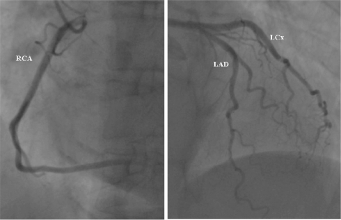 Figure 2 Normal coronary angiogram from the patient with small anterior subendocardial infarction. This patient had recently diagnosed diabetes mellitus. Coronary angiography did not revealed any signs of obstructive atherosclerotic plaque in the large epicardial arteries. (Left panel) left anterior oblique view of the right coronary artery. (Right panel) Right anterior oblique view of left anterior descending artery (LAD) and left circumflex artery (LCx).