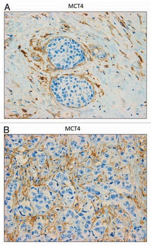 Figure 5 MCT4 is expressed in the fibroblastic stromal compartment of human breast cancers. Note that MCT4 staining is selectively localized to the fibroblastic tumor stromal compartment of human breast cancers. Two representative images are shown. Both clearly show that MCT4 staining is absent from the tumor epithelial cells, but is present in the surrounding stroma. Panel (A) shows DCIS-like lesions and the surrounding MCT4(+) tumor stroma. Panel (B) shows that MCT4 staining outlines the cancer-associated fibroblasts that surround nests of epithelial cancer cells. Original magnification, 40×.
