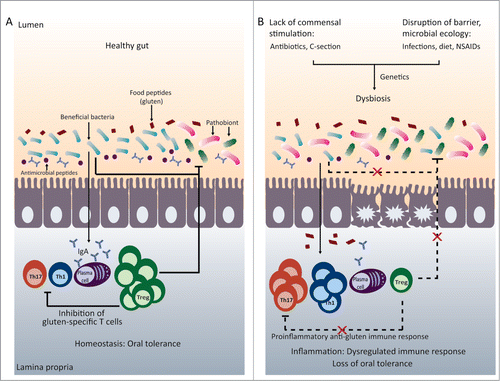 Figure 1. Microbiota and immune homeostasis in oral tolerance. (A) In the healthy gut there is a balance between beneficial bacteria and potentially harmful bacteria (pathobionts). This results in intestinal homeostasis with a balance between the pro-inflammatory Th1 and Th17 cells and regulatory T cells, allowing the generation of oral tolerance to food proteins such as gluten. (B) A disruption of early microbial colonization (C-section, neonatal antibiotic use) or a disruption of barrier function or microbial ecology (changes in diet, infections, or drugs) can results in intestinal dysbiosis. This can lead to imbalances between pro-inflammatory and regulatory immune cells. In genetically susceptible individuals, immune imbalances may promote loss of tolerance to food proteins, such as gluten.