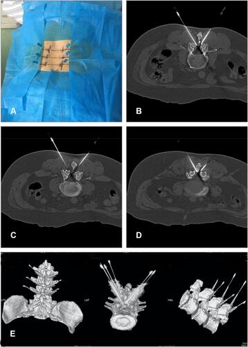 Figure 3 (A) Needle-knife position on the body surface: (B) for L2/3; (C) for L3/4; (D) for L4/5. (E) 3-D reconstruction.