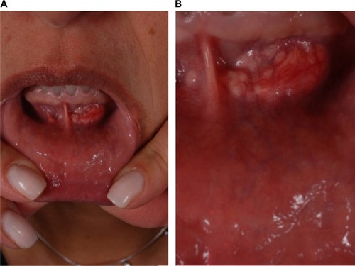 Figure 8 Noninflammatory nodule.