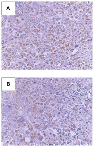 Figure 2 Immunohistochemistry sections of CDC 47 tumor cells in Ehrlich solid tumor-bearing Swiss mice treated by IV route at doses of 16 mg/kg with (A) SpHL, and (B) SpHL-CDDP.Abbreviations: IV, intravenous; SpHL, long-circulating and pH-sensitive liposomes; SpHL-CDDP, long-circulating and pH-sensitive liposomes containing CDDP (cisplatin).