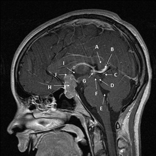 Figure 2 Midline sagittal T1 MRI with gadolinium of bifocal pineal region/suprasellar germinoma in a 15-year-old female patient. The patients had signs and symptoms of headache, bitemporal hemianopia, and polydipsia. Diagnosis was made via transsphenoidal resection of the suprasellar component of the mass to relieve the visual compromise. Arrows point out key structures as follows: (A) – splenium of corpus callosum; (B) – Vein of Galen; (C) – quadrigeminal cistern; (D) – inferior and superior colliculi; (E) – 4th ventricle; (F) – cerebral aqueduct; (G) – very small pineal germinoma, homogeneously enhancing; (H) - large sellar/suprasellar component of germinoma enhancing; (I) – 3rd ventricle; (J) – location of elevated and compressed optic chiasm (not well visualized).