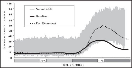 Figure 3 Laser Doppler perfusion response to heating for baseline and post-etanercept treatment. The grey area is normal. a month and a half, we conclude his continued improvement in autonomic function is from the etanercept.