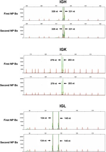 Figure 4. Polymerase chain reaction for IGH, IGK and IGL genes. The first and second nasopharyngeal biopsies showed identical amplification peaks.