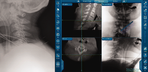 Figure 3. Left: Preoperative radiograph showing the difficulty in finding the correct level (C6-7 level) for the surgical approach. Right: O-arm navigation images allowing proper localization of the level and laminofacet junction.