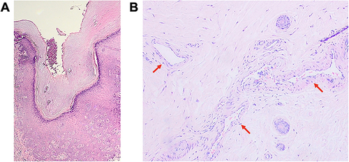 Figure 2 Histopathological feature revealed (A) hyperkeratosis and acanthosis; (B) vasodilatation and perivascular lymphocytic infiltrates (red arrows).