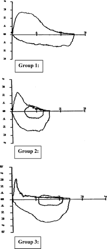 Figure 1 Typical examples of the flow volume loops for group 1 (preserved ratio), group 2 (intermediate) and group 3 (dynamic airway collapse).