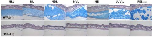 Figure 3 Cross section of sites with subcutaneously implanted HA dermal fillers (4-day filler residence time) before and two weeks after injection with 30 IU hyaluronidase (HYAL) per 0.1-mL HA filler volume. Alcian blue-stained areas show the HA filler layer before HYAL injection (top) and 2 weeks after treatment (bottom).