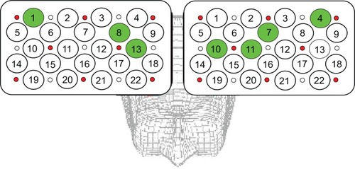 Figure 4 Cortical distribution of significant correlations between activation and PANSS scores.