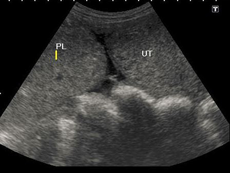 Figure 2 The placenta is seen separately adjacent to the uterine fundus.