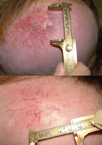 Figure 2. Treatment of a scalp metastatic lesion with electrochemotherapy. Images are representative of pre-treatment (A) and 3 months post-treatment follow-up (B).