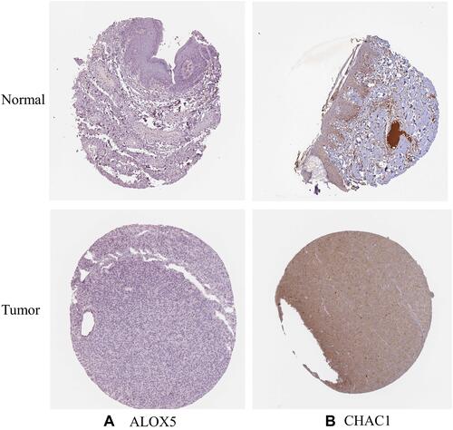 Figure 4 The expression of hub ferroptosis-related genes was tested using the HPA database in SKCM and normal tissue. (A) ALOX5 (B) CHAC1.