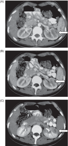 Figure 1. Focal heterogeneous hypodense zone in the anterolateral cortex of the left kidney in arterial phase (A), which became evident in the venous (nephrogram) phase (B). In pyelogram phase images, this hypodense zone became evident: when the margins of this perfusion defect were sharpened by expanding them to 34 mm, the hypodense zone became even more evident (C) (arrows point at the renal vascular damage lesion).