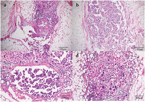 Figure 1. Histopathology staining of malignant peritoneal mesothelioma from patient. (a) and (b): HE staining showing a migration between malignant tumor cells and normal mesenteric mesothelial cells. Invasive growth and obvious nuclear atypia are shown in tumor cells (100×). (c) and (d): HE staining showing the tumor cells are in the epithelioid cell morphology, with large nuclear staining, coarse chromatin and obvious nucleoli (200×).