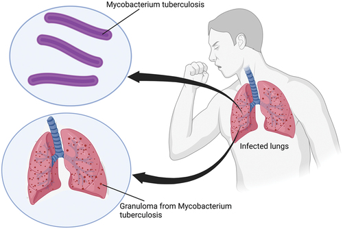 Figure 1. Mycobacterium tuberculosis (MBTB).