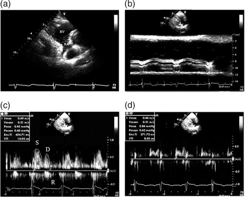 Fig. 1 The measurement of coronary blood flow in the CS. (a) The CS seen from the parasternal right ventricular inflow tract view. (b) The measurement of the diameter of CS using adjust M-Mode ultrasonography. (c) The Doppler spectrum of coronary blood flow in the CS obtained from the parasternal right ventricular inflow tract view and the measurement of Doppler parameters of coronary blood flow in the CS by digitized Doppler spectral envelopes in normal subjects. (d) The measurement of Doppler parameters of coronary blood flow in the CS by digitized Doppler spectral envelopes in patients with CAD (d). RA = right atrium; RV = right ventricle; CS = coronary sinus; S = systolic wave of the antegrade blood flow; D = diastolic wave of the antegrade blood flow; R = retrograde blood flow; Env.Ti = duration of measured envelope; CAD = coronary artery disease.