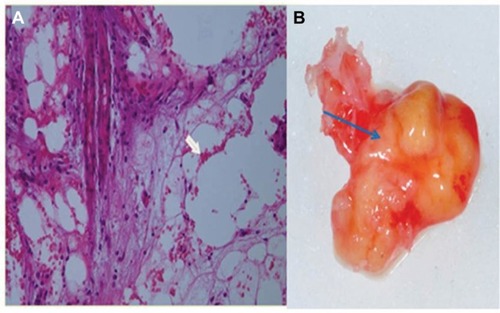 Figure 7 (A) A cluster of dead fatty cells (white arrow) with small inflammatory cells observed in the medullary cavity of the jaw. (B) An FDOJ tissue sample with complete fatty transformation of the cancellous portion of the jawbone (blue arrow).