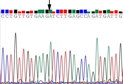 Figure 1 DNA sequencing results of hsa_circ_0000711 in colorectal cancer tissues.Note: The arrow points to the cyclation site.