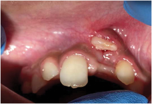 Figure 2. Appointment 1 intraoral photo taken two weeks after initial injury.